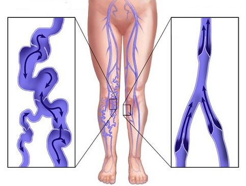 Comparación de venas afectadas por venas y venas varicosas después de usar Veniselle
