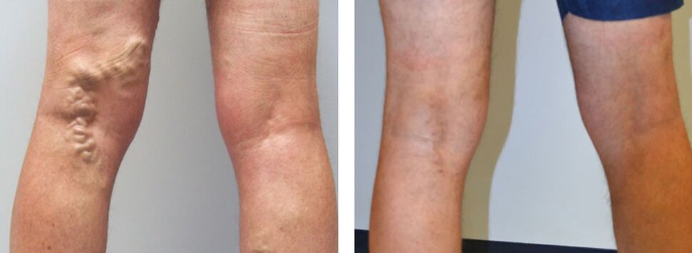 Foto antes y después de usar Veniselle, experimente en el uso de la crema