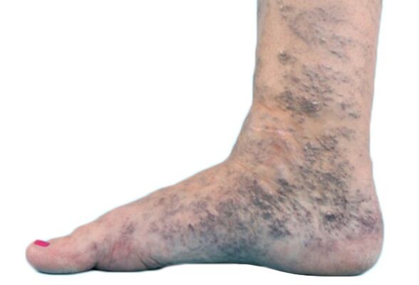 Varices en las piernas