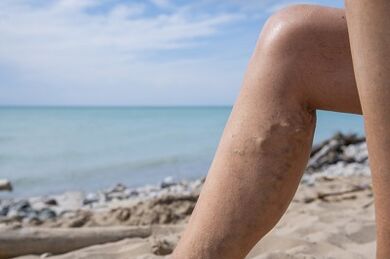 Varices en las piernas