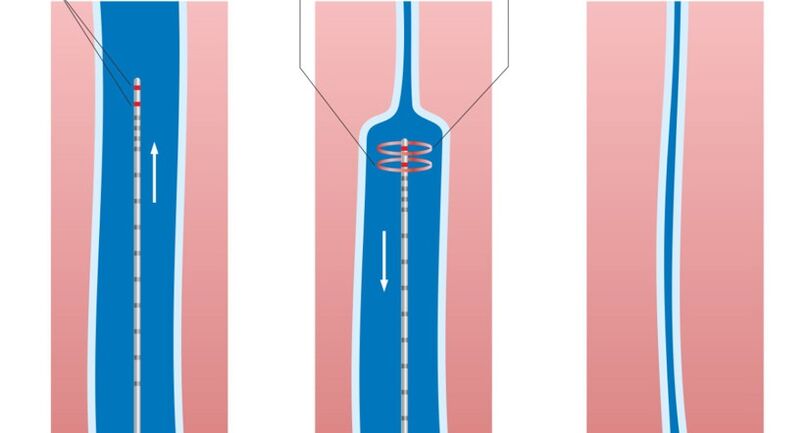 Tratamiento con láser para las venas varicosas de las piernas.