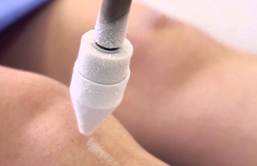 tratamiento de las venas varicosas de las piernas mediante crioterapia