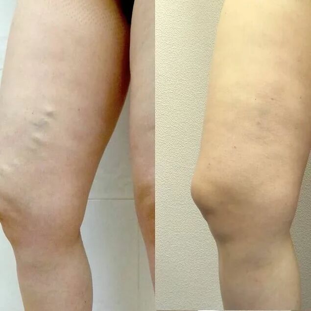 Antes y después del tratamiento de varices.